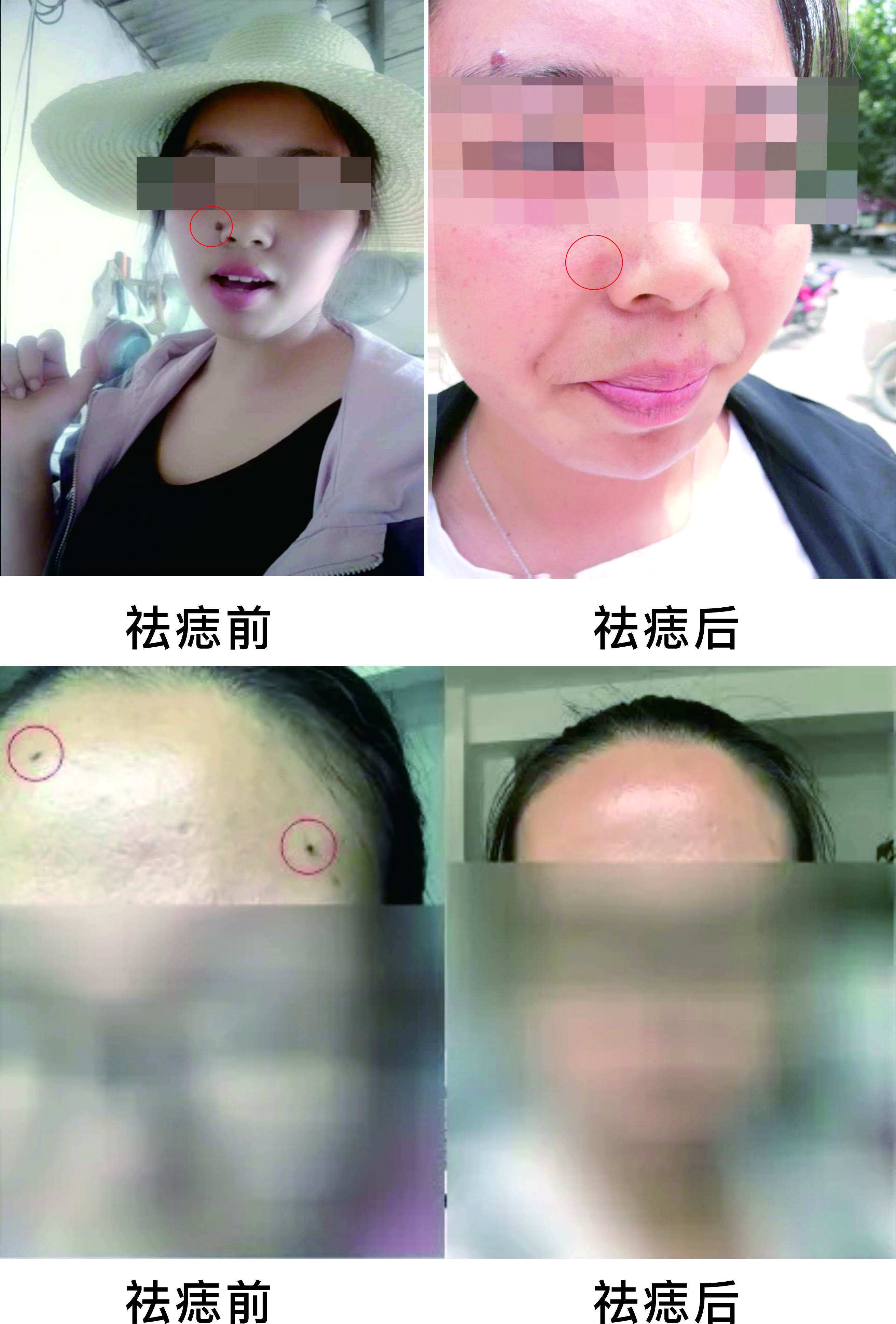 微波祛痣，告別臉部多余的“點(diǎn)綴”~